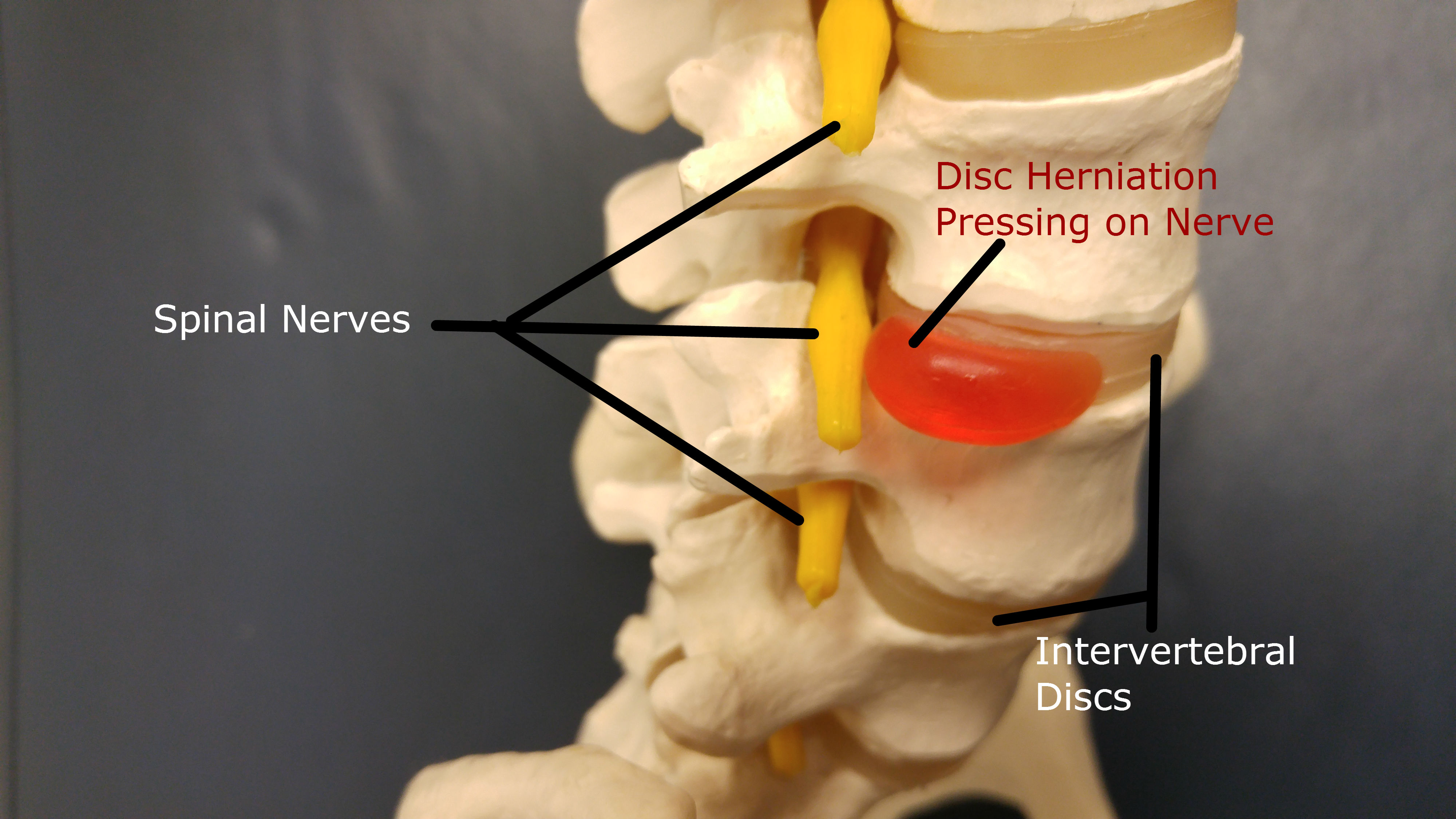 disc herniation